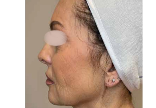 Onda podbrodek przed