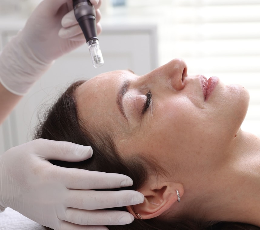 Dutasteryd PRO – terapia trychologiczna RedTouch PRO + mezoterapia mikroigłowa: włosy